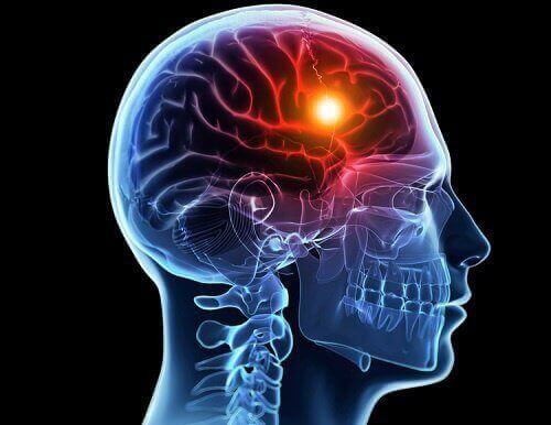 8 kehon varoitusmerkkiä aivohalvauksesta