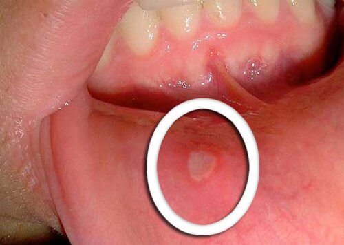 nielusyöpä voi näyttäytyä suun haavaumina