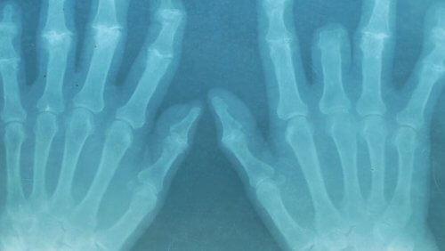 röntgenkuva käsistä