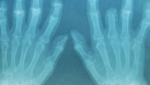 röntgenkuva käsistä