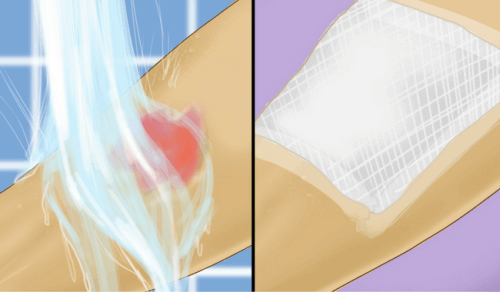 Ensiapu kuuman veden aiheuttamiin palovammoihin