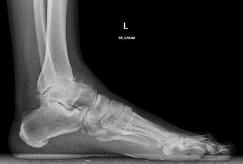 röntgenkuva jalasta