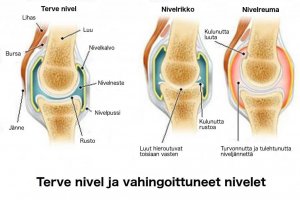 Niveltulehdus, nivelrikko ja osteoporoosi - mitkä niiden erot ovat?