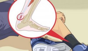 5 hoitoa akillesjänteen tulehdukseen