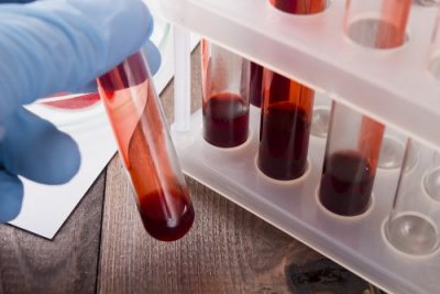 Hyviä uutisia: syöpä voidaan nyt havaita verikokeella
