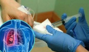 Uusi lääke kemoterapian sivuoireiden lievittämiseksi