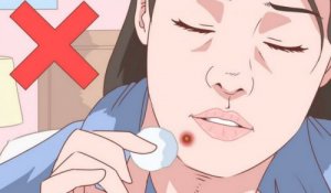 Toimiva luonnollinen hoito leuan akneen