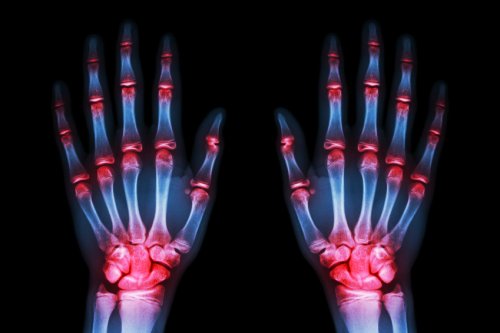 röntgenkuva käsistä