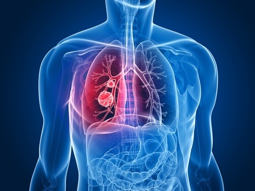 keuhkosyöpä