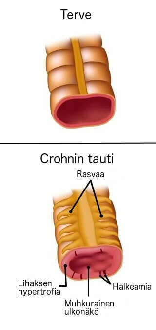 mikä on Crohnin tauti
