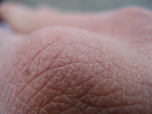 Rasvahappojen puutoksen oireita on mm. kuiva iho