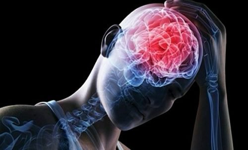 Aivojen embolia on yksi aivoverenkierron häiriötyyppi.