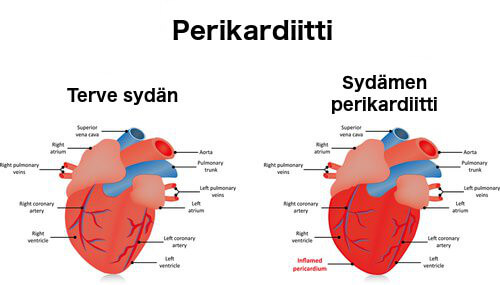 Perikardiitti eli sydänpussitulehdus.