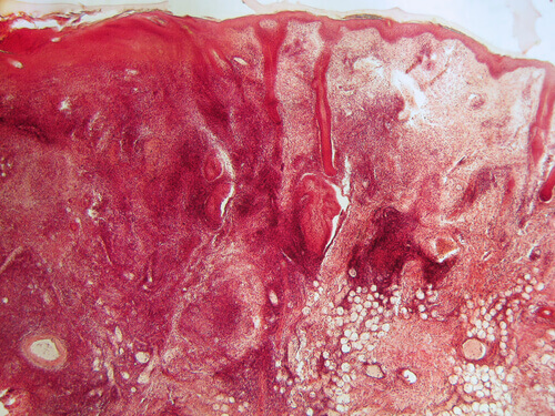 Punahukka on yleisempää naisilla.