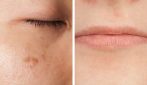 5 tapaa, joilla kasvosi kertovat vitamiinipuutoksista