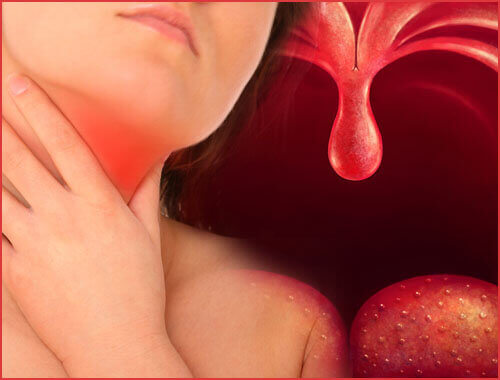 nielutulehduksen hoito