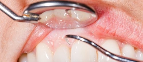 14 syytä sille, miksi ikenet vuotavat verta hampaita harjatessa