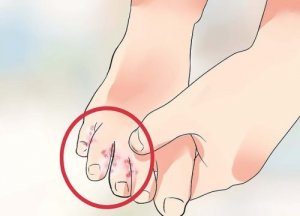 7 luonnollista hoitoa jalkasieneen