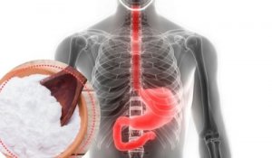 Närästyksen hoito ruokasoodalla