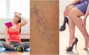 8 keinoa estää hämähäkkisuonia jaloissa