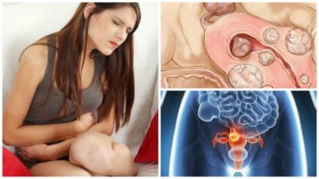 5 faktaa kohdun fibroideista 5 faktaa kohdun fibroideista