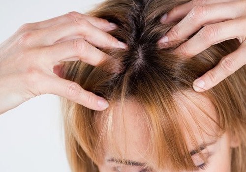 hiero päänahkaa hiustenlähdön estämiseksi