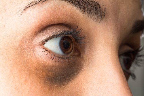 hormonaalinen epätasapaino aiheuttaa silmäpusseja