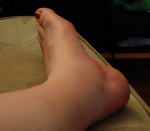 5 ongelmaa, joista turvonneet nilkat voivat viestiä