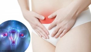 Endometrioosin oireet ja hoidot
