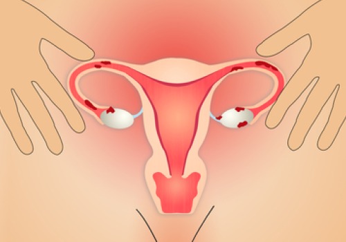 endometrioosi