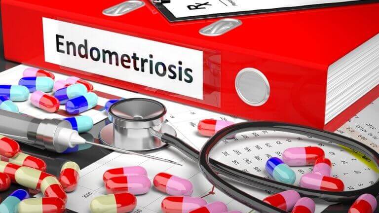 Endometrioosin hoito on tapauskohtaista.