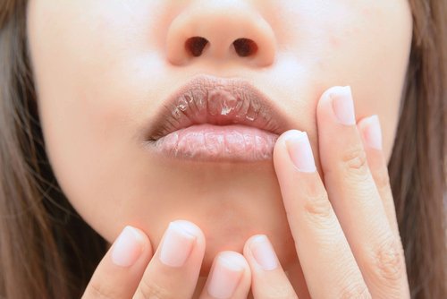 kuivat huulet voivat olla ravinnepuutosten merkki