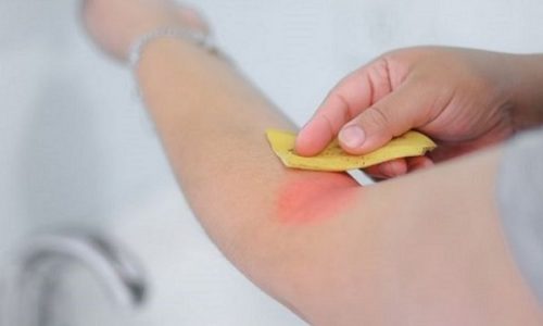 voit käyttää banaaninkuoria pistosten lievittämiseen