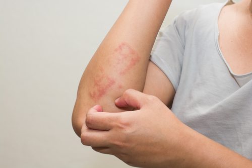 psoriasis käsivarressa