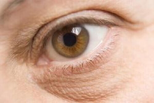 turvonneet silmänalukset voivat olla ravinnepuutosten merkki