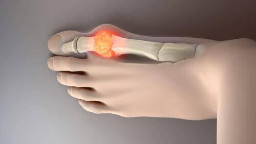 Kokeile näitä 8 ruokaa vähentämään virtsahappoa