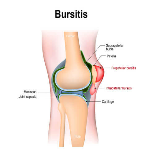 bursiitti