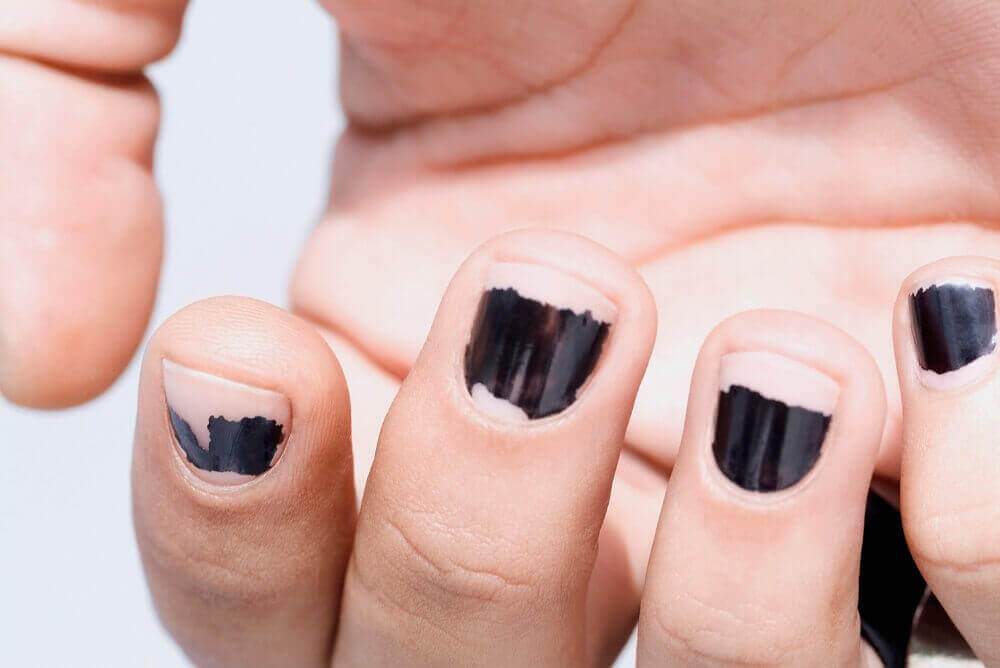 kynsilakan poisto vaikuttaa kynsien haurauteen