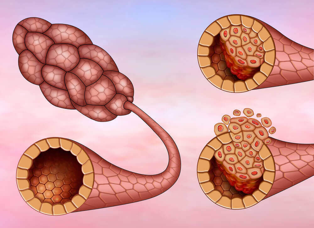Erilaiset rintasyöpätyypit - duktaalinen karsinooma on yleisin.
