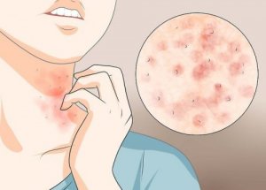 Kolme helppoa kotikonstia syyhyyn