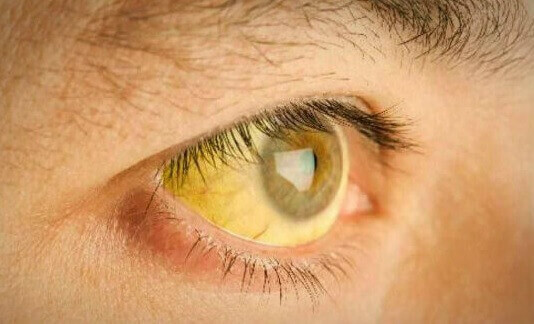 keltaiset silmät voivat olla merkki tulehtuneesta maksasta