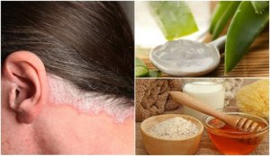5 kotihoitoa päänahan psoriasikseen