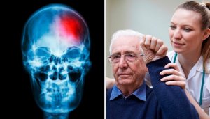 Mikä on miniaivohalvaus?