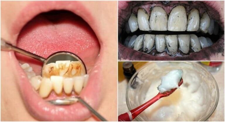 3 tehokasta kotihoitoa hammaskiveen
