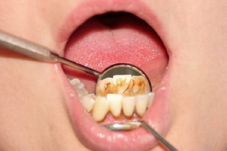 Bakteerit, ruuanjäämät ja mineraalisuolot kerääntyvät hampaan pinnalle hammaskiveksi.