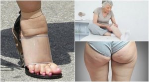 5 yleistä nesteen kertymisen oiretta