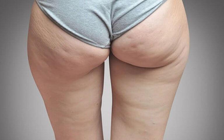 pakaroissa selluliittia: nesteen kertymisen merkki