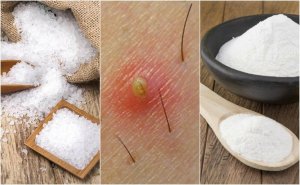 5 luonnollista hoitoa sisäänpäin kasvaneille ihokarvoille