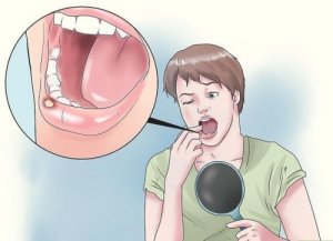 8 luonnonmukaista parannuskeinoa aftoihin