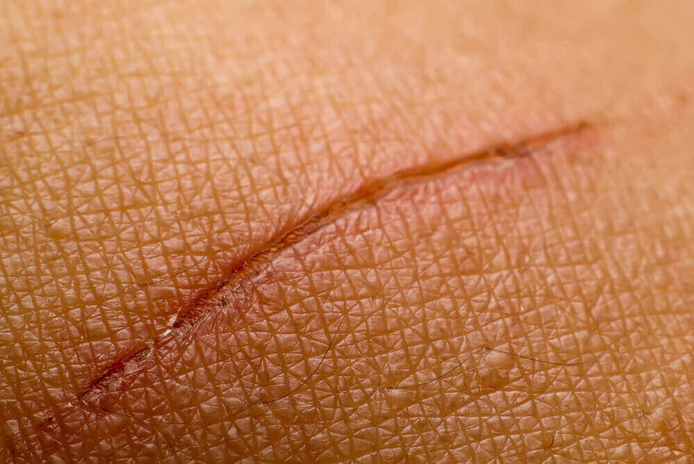havaitse diabetes: haavat eivät parane